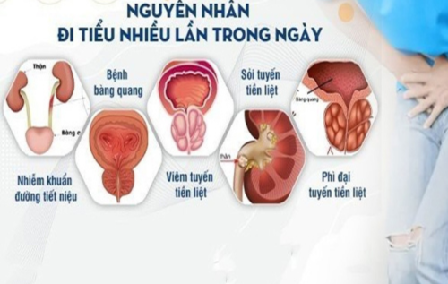 Tiểu nhiều lần dấu hiệu bệnh lý không nên chủ quan