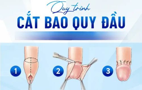 Quy trình cắt bao quy đầu tại Phòng khám Kiên Khang Biên Hòa