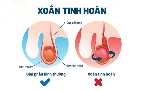 Hình ảnh bệnh xoắn tinh hoàn